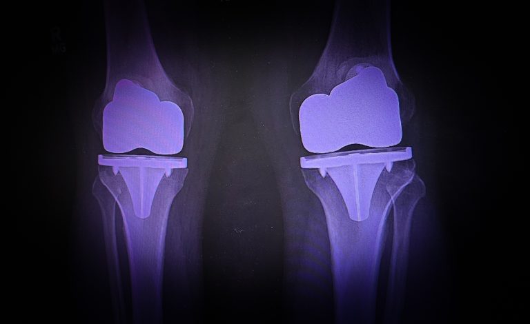 Stronger Than Before: Rebuilding Leg Strength at Home After Double Knee Replacement at 57.