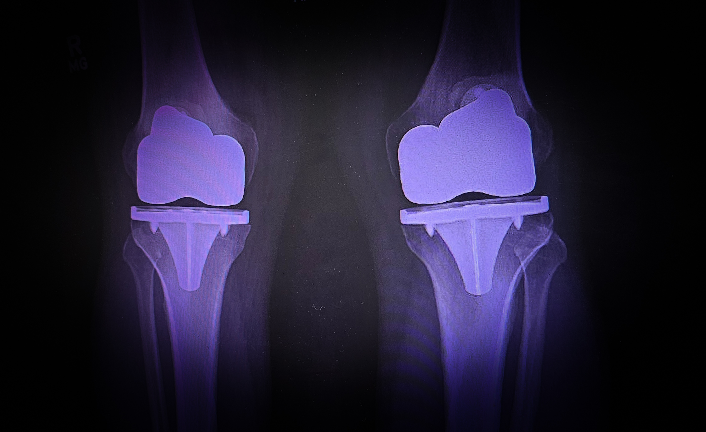 Stronger Than Before: Rebuilding Leg Strength at Home After Double Knee Replacement at 57.