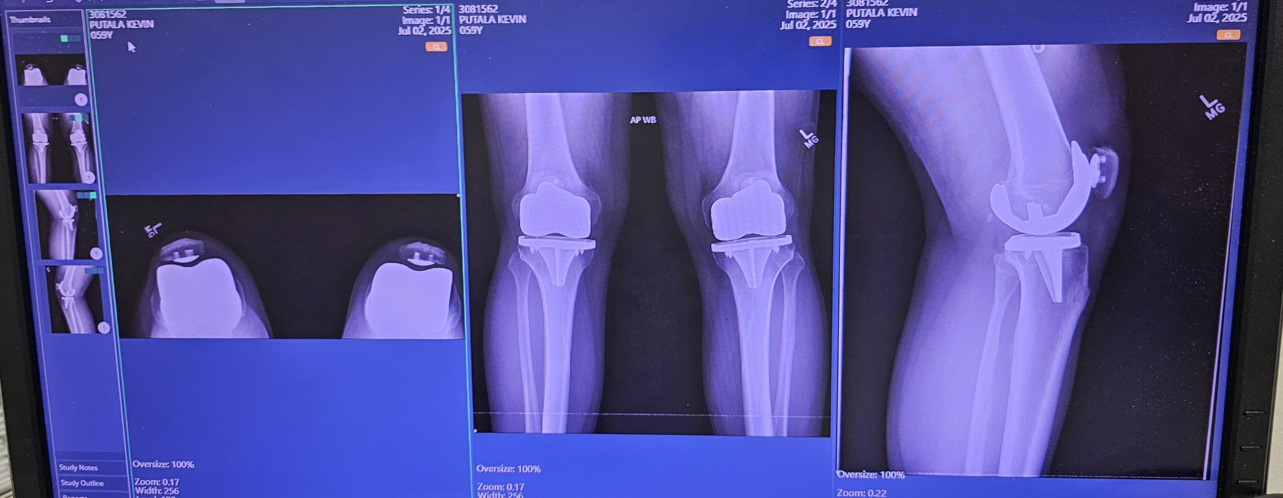 Adapting Martial Arts for Physical Limitations