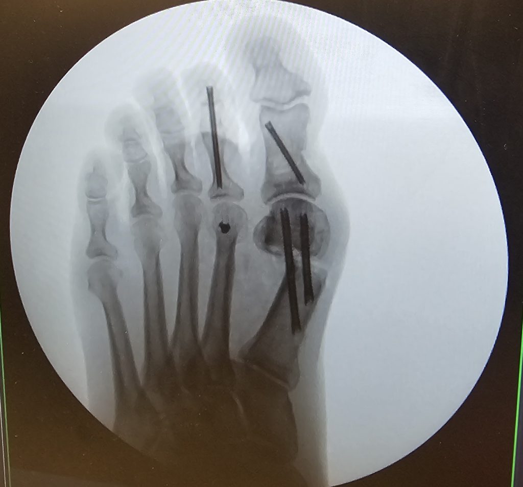 My X-Ray after foot surgery